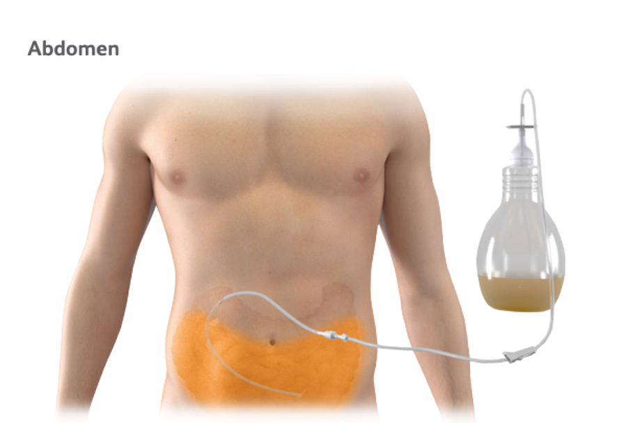 Peritx Peritoneal Catheter System Obex